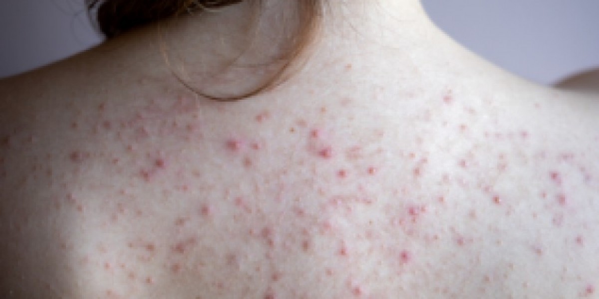All About Back And Body Acne: Causes And Treatm