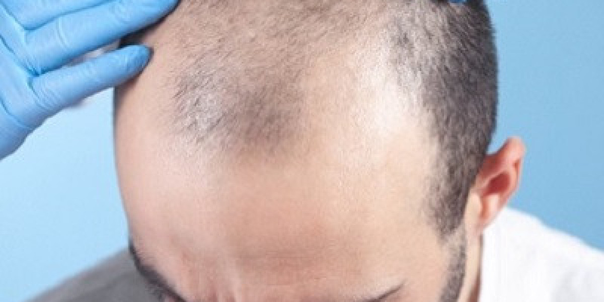 FUT Hair Transplant Care Tip for Muscat Patient