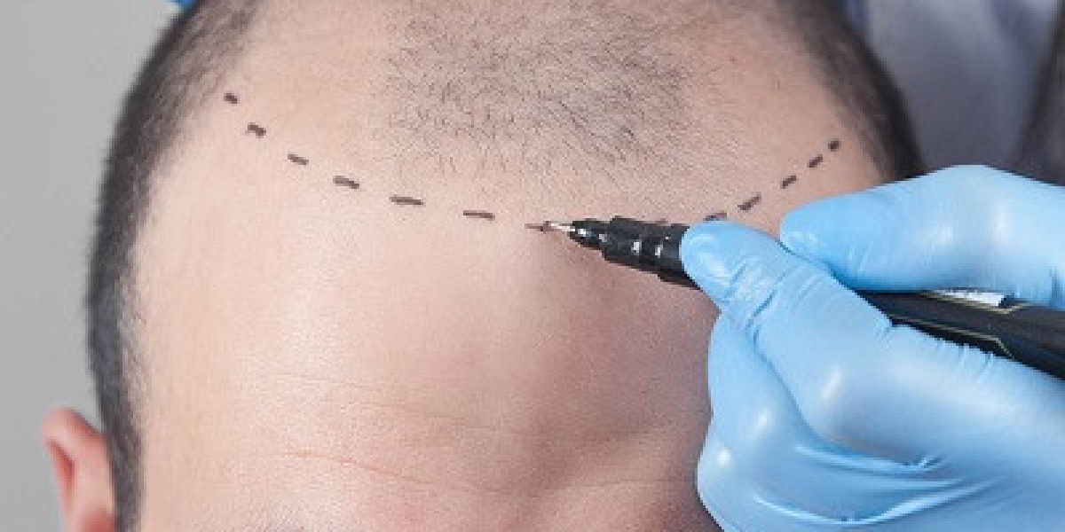 FUT Hair Transplant: Common Myths Debunked