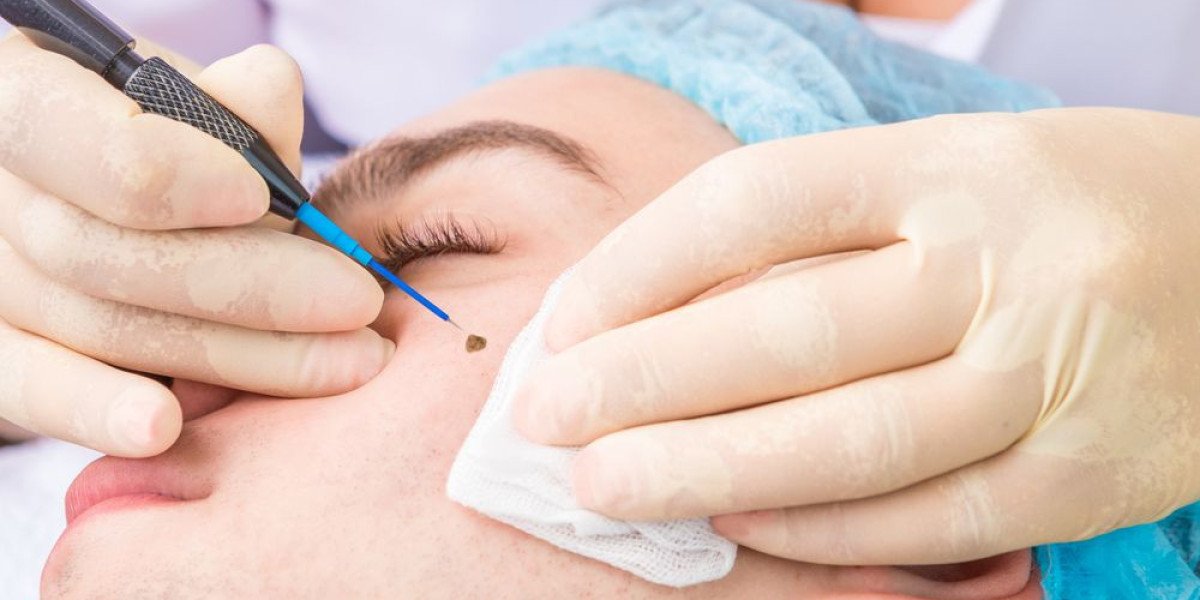 Expert Mole Removal Surgery in Riyadh: Your Pat