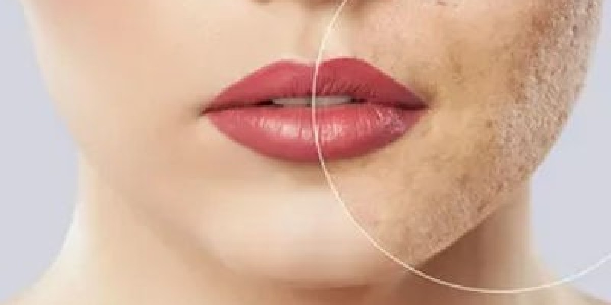 Exploring the Benefits of PRP Therapy for Acne