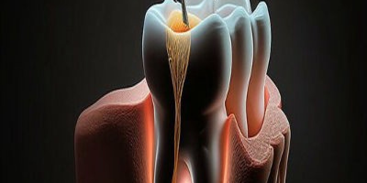 Guide for Expats: Where to Get a Root Canal in