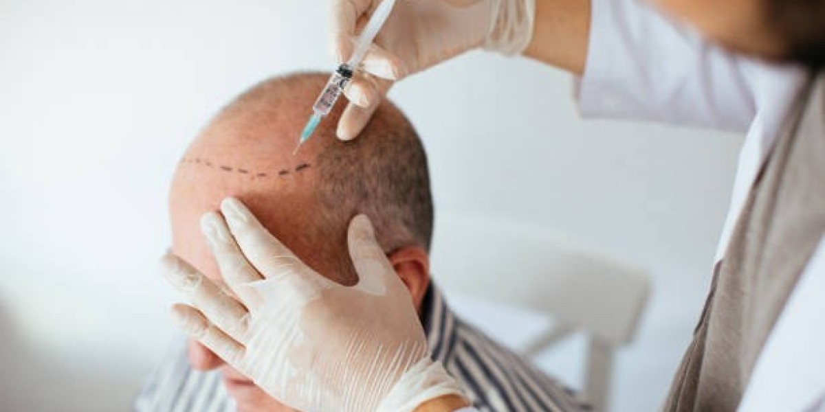 زراعة الشعر في الرياض بدون ألم وتكلفة معقولة