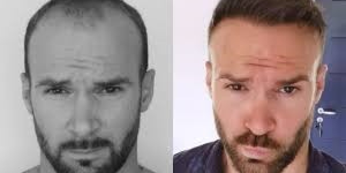 Antalya, Turkey's Top Hair Transplant Clinics