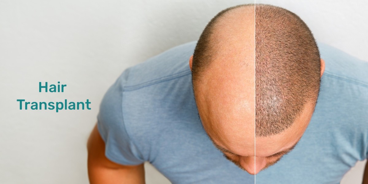 Hair Transplant in Noida for Men and Women