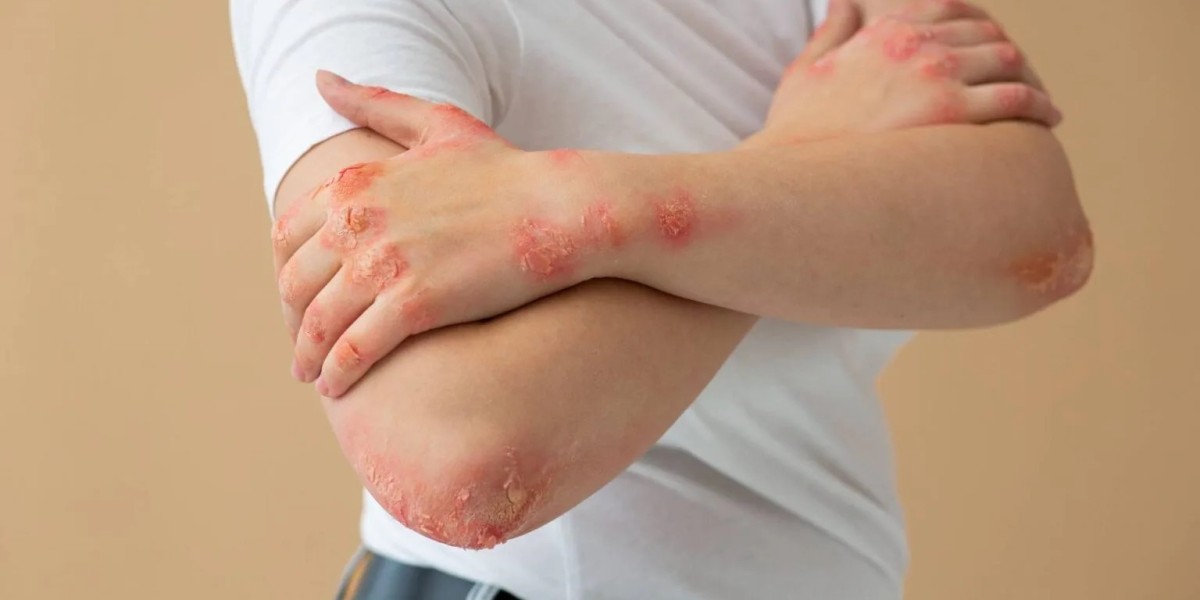 Psoriasis Treatment in Delhi Best Dermatologist