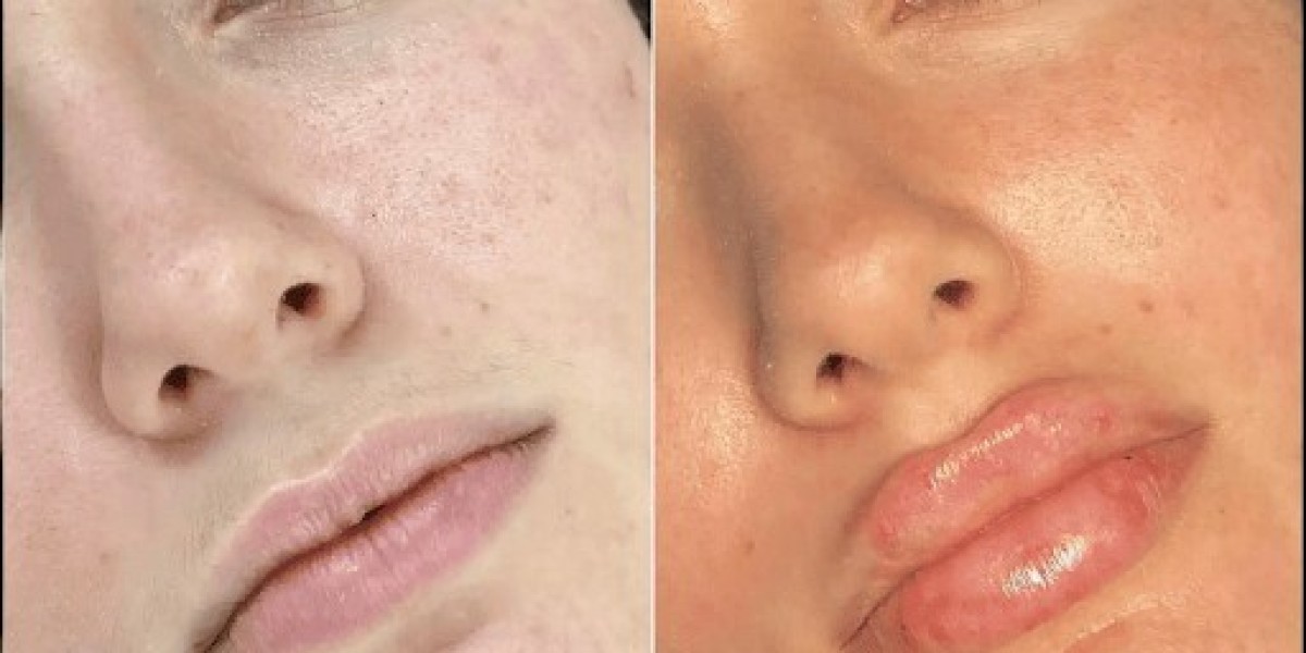 Your Guide to Fillers Treatment in Dubai