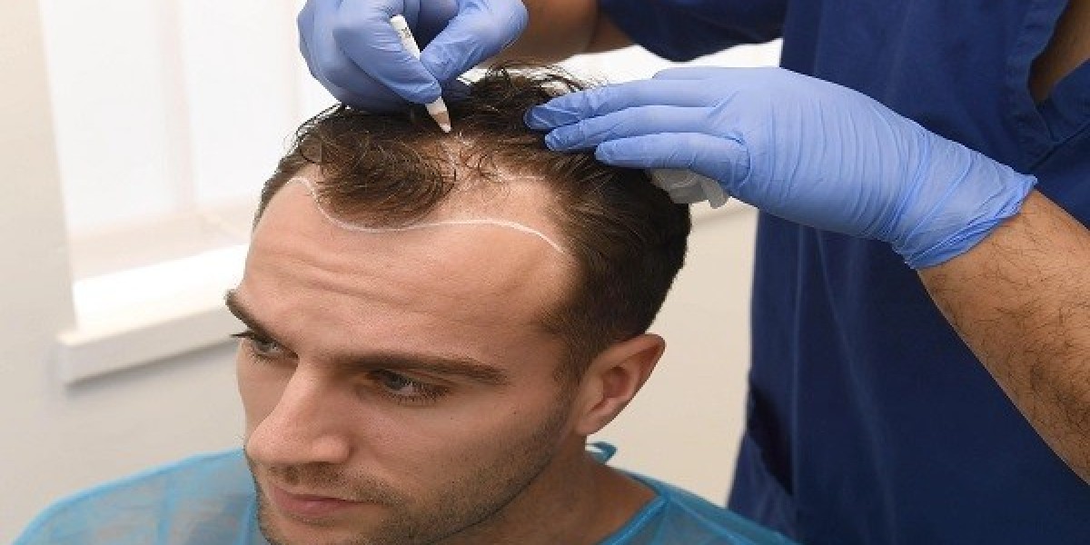 Is Hair Transplant Painful? What Patients in Is