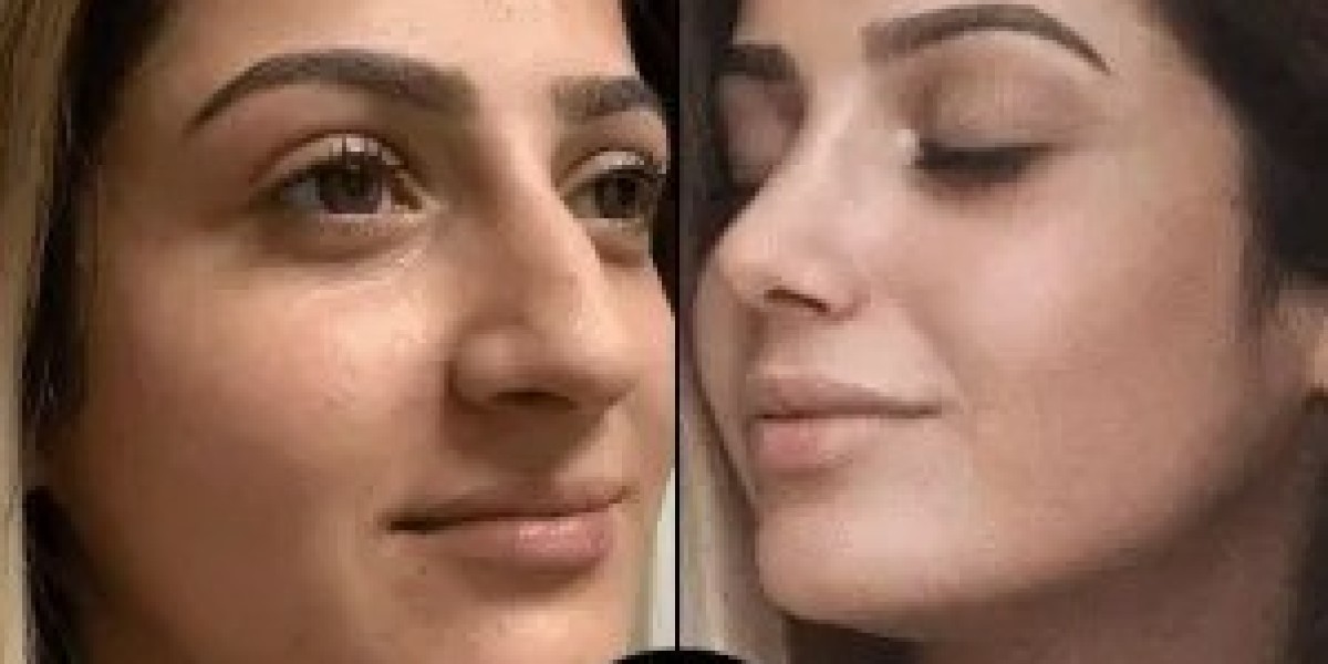 PRP Treatments in Dubai for Face, Scalp, and Bo