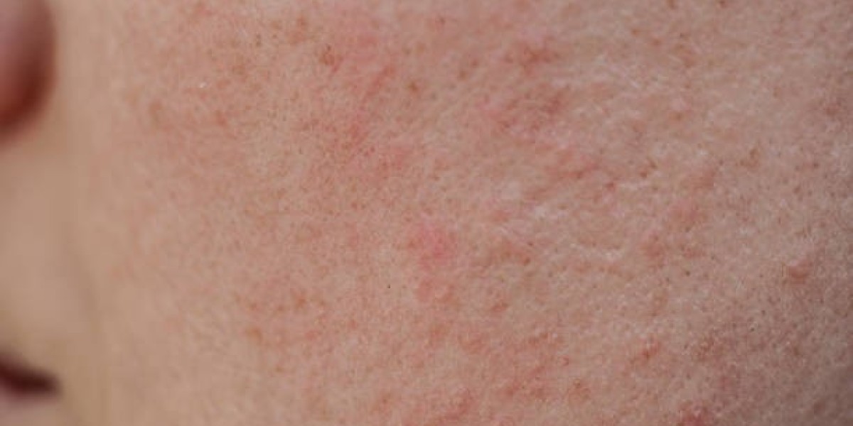 Large Pores: Control Oil, Shrink Pores