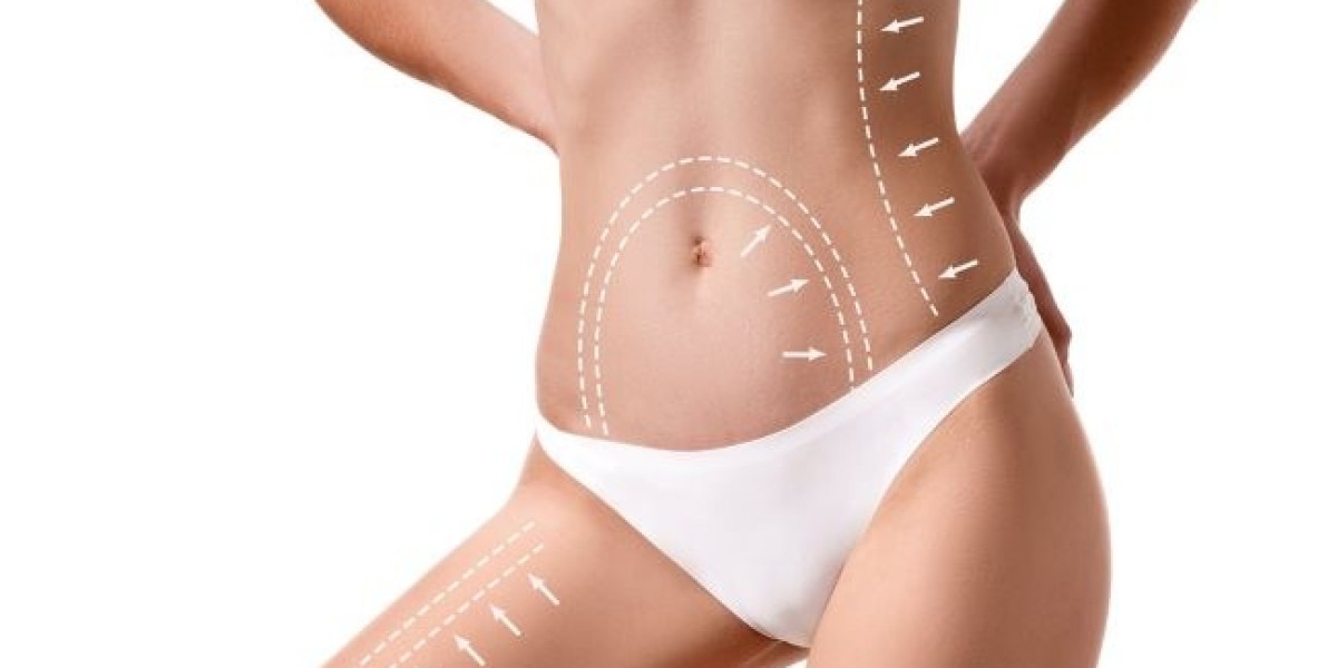 Can Liposuction Help with Weight Loss? What You