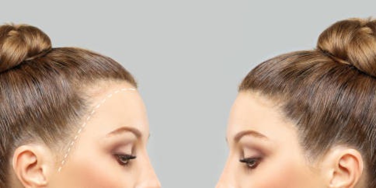 استعد لتغيير مظهرك مع زراعة الشعر في الرياض بأح
