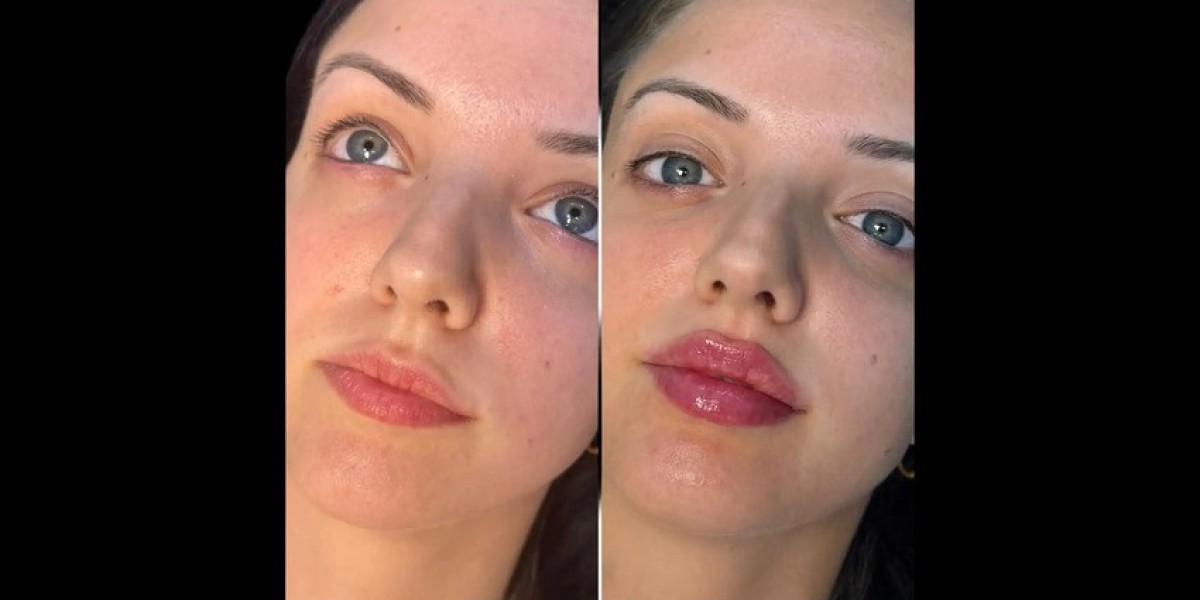 How Safe Are Fillers Treatments in Dubai