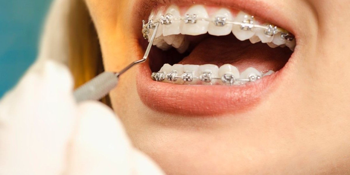 10 Braces Care Tips Every Patient Should Know