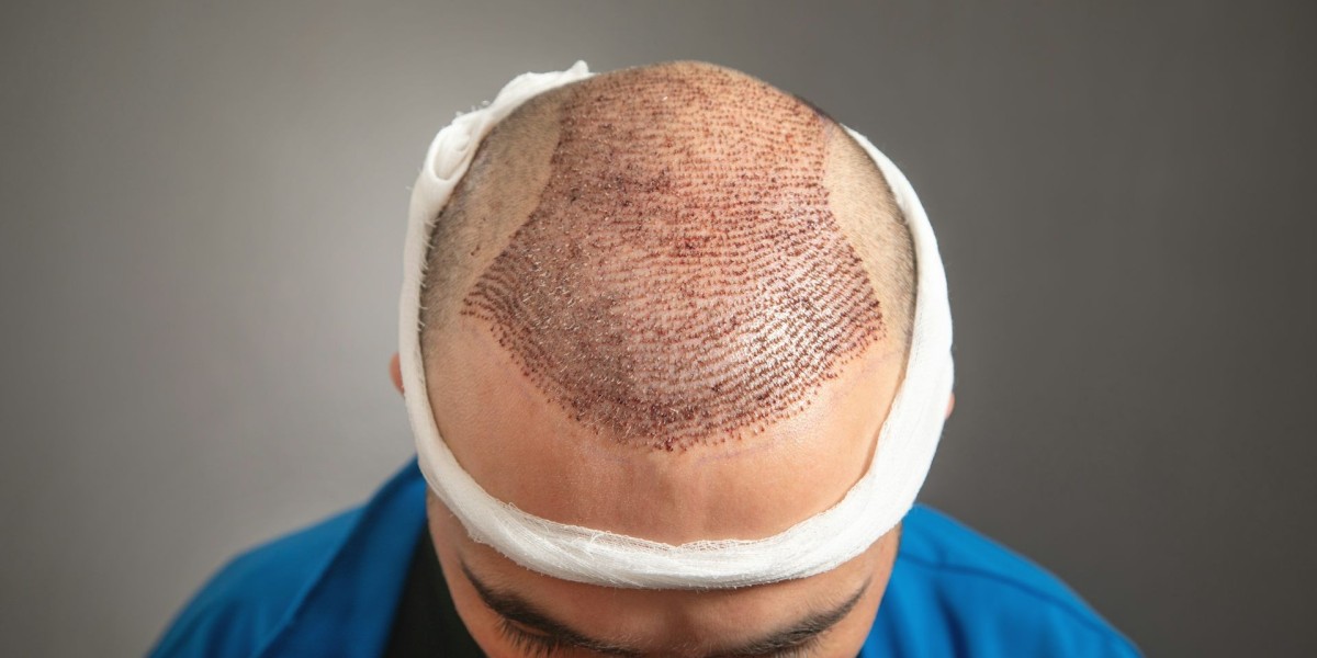 Why Hair Transplant Costs Vary in Islamabad