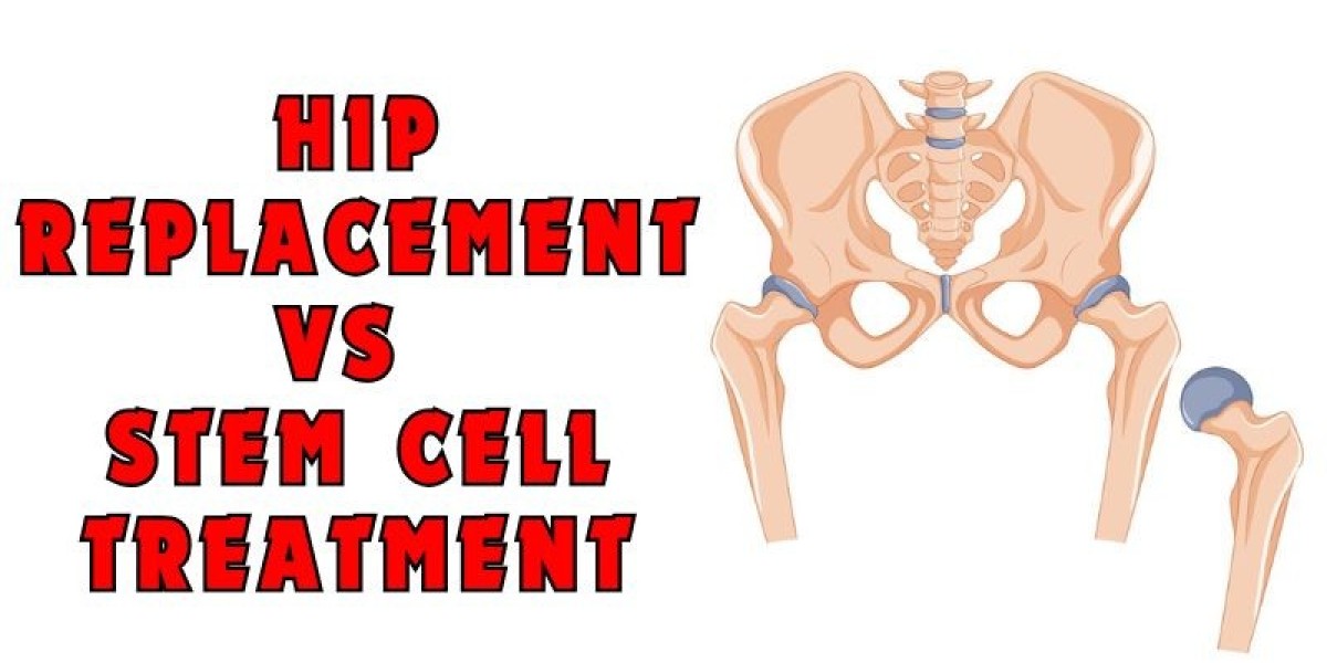 A Guide Hip Replacement vs Stem Cell Treatment