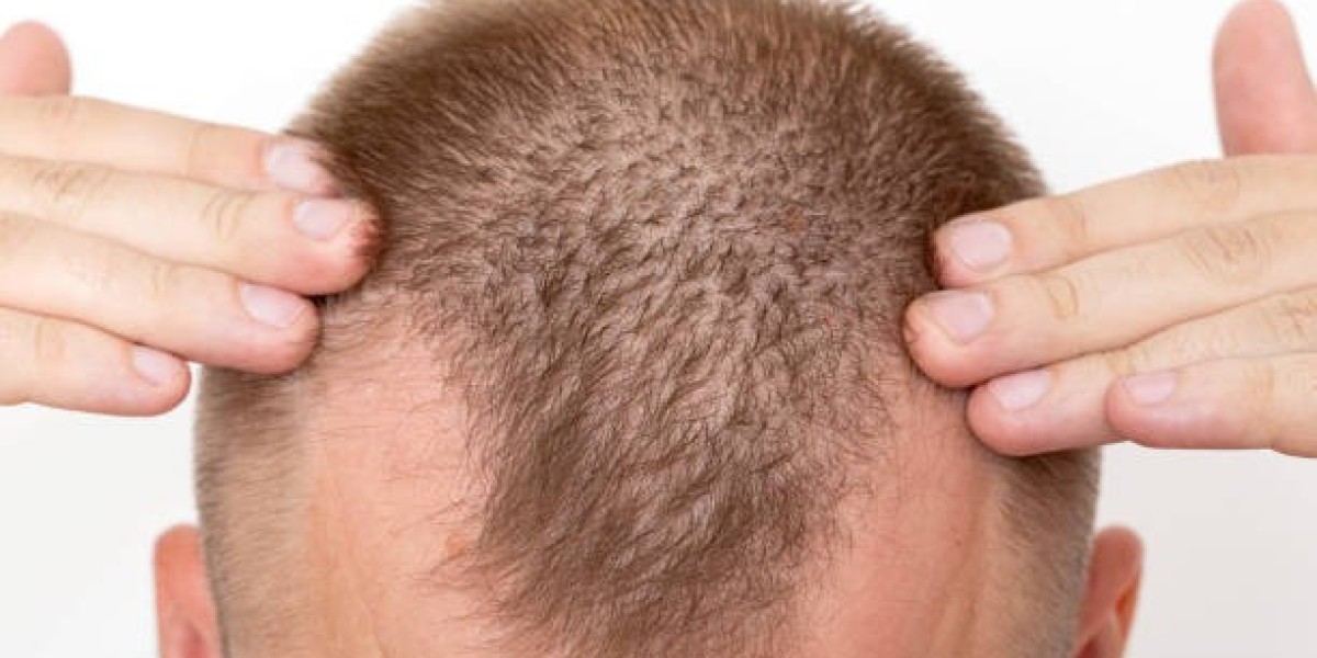 زراعة الشعر في الرياض: هل يغطيها التأمين الصحي؟