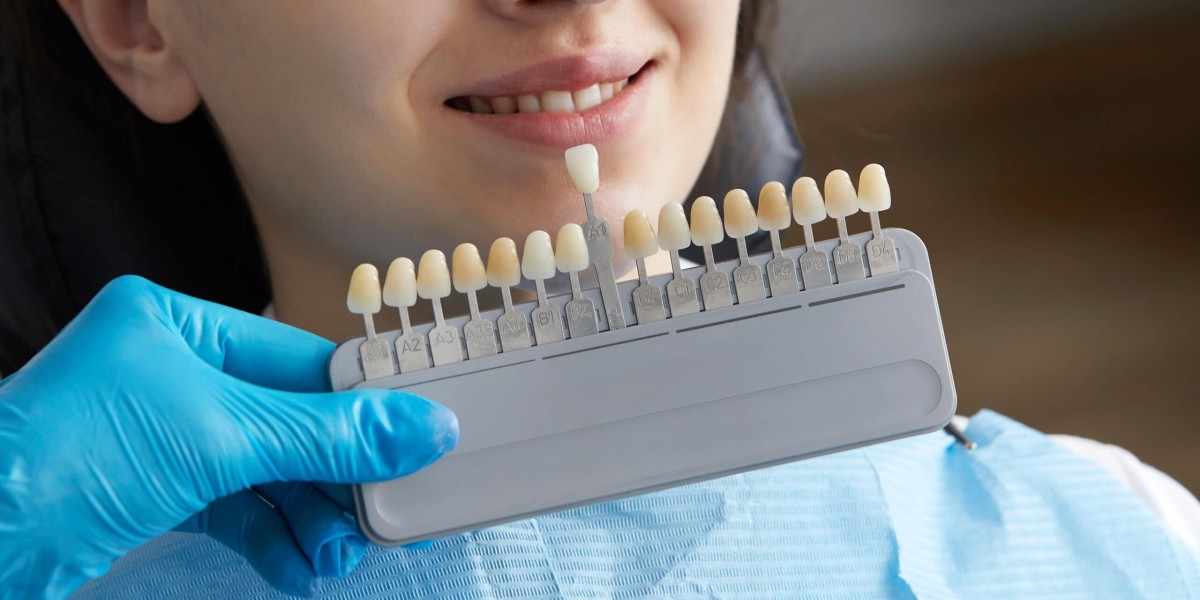Transform Your Smile with Composite Veneers