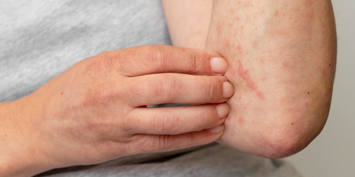 Chronic Spontaneous Urticaria Market