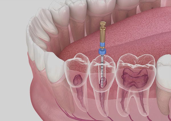 Root Canal Treatment in RR Nagar. Tooth pain can be one of the most… | by Symphonysmiles | Aug, 2025 | Medium
