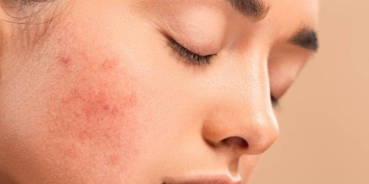 Acne Scars & Pigmentation Solution in Islamabad