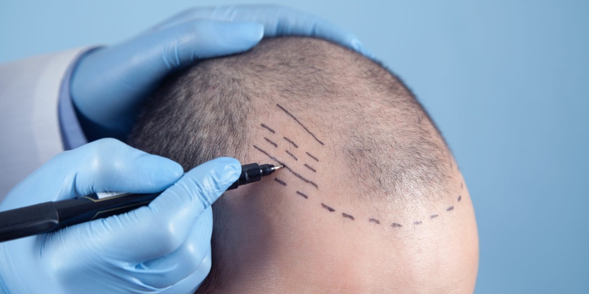 How Surgeons Plan Graft Distribution in Crown T