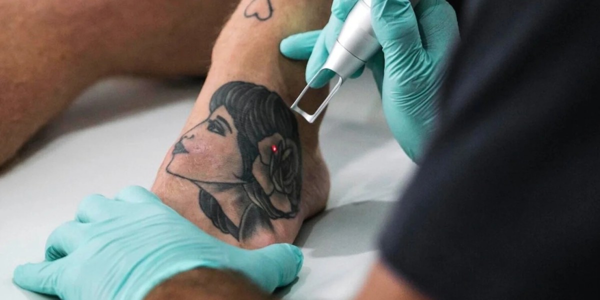 Real Glow Returns with Laser Tattoo Removal