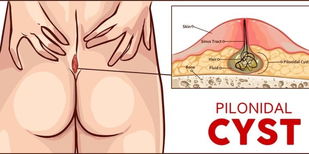Smart Habits to Prevent Pilonidal Disease Recur