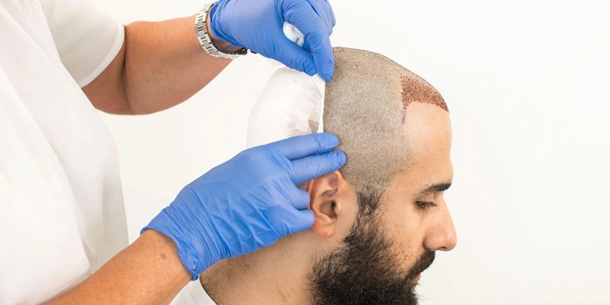 Hair Transplants: The Gateway to a New You