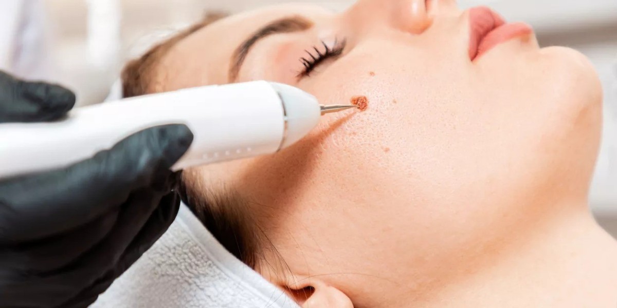 Top Skin Wart Removal Techniques Explained