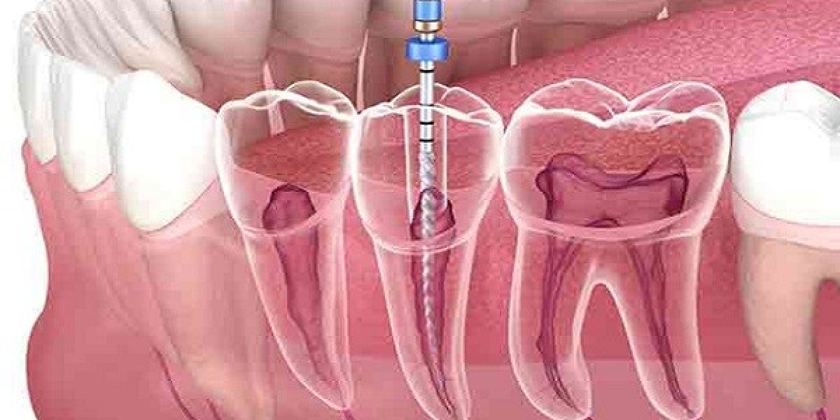 Payment Plans for Root Canal Treatment