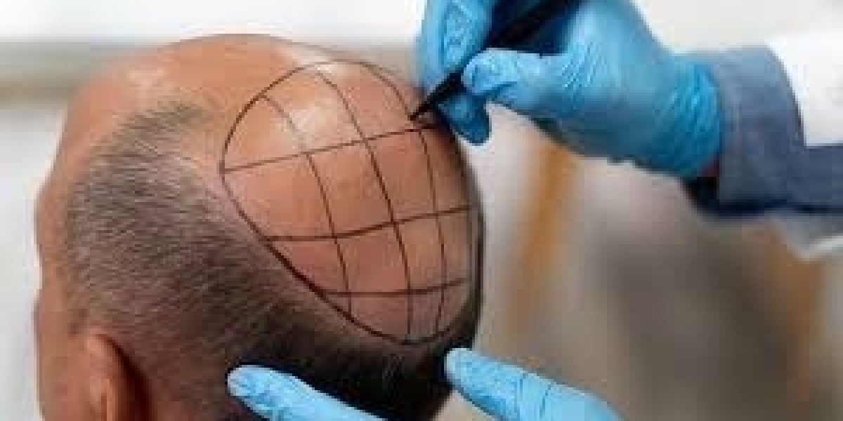 Howmuchtime it take to heal from HairTransplant