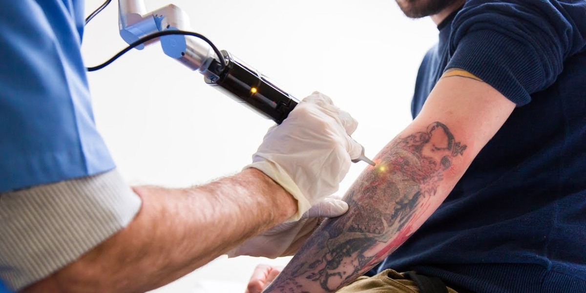 Eco-Friendly Tattoo Removal: Is It Possible?