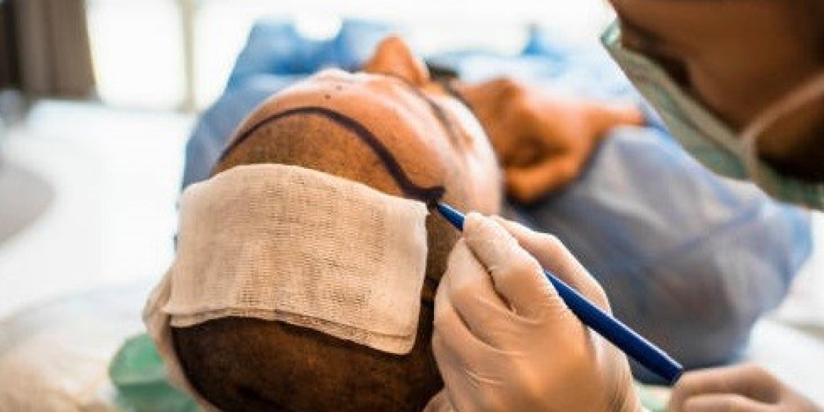 Is a hair transplant permanent?