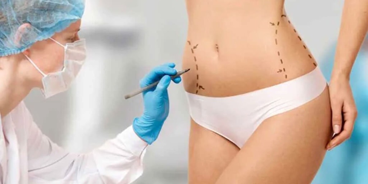 Liposuction in Islamabad: Key Facts