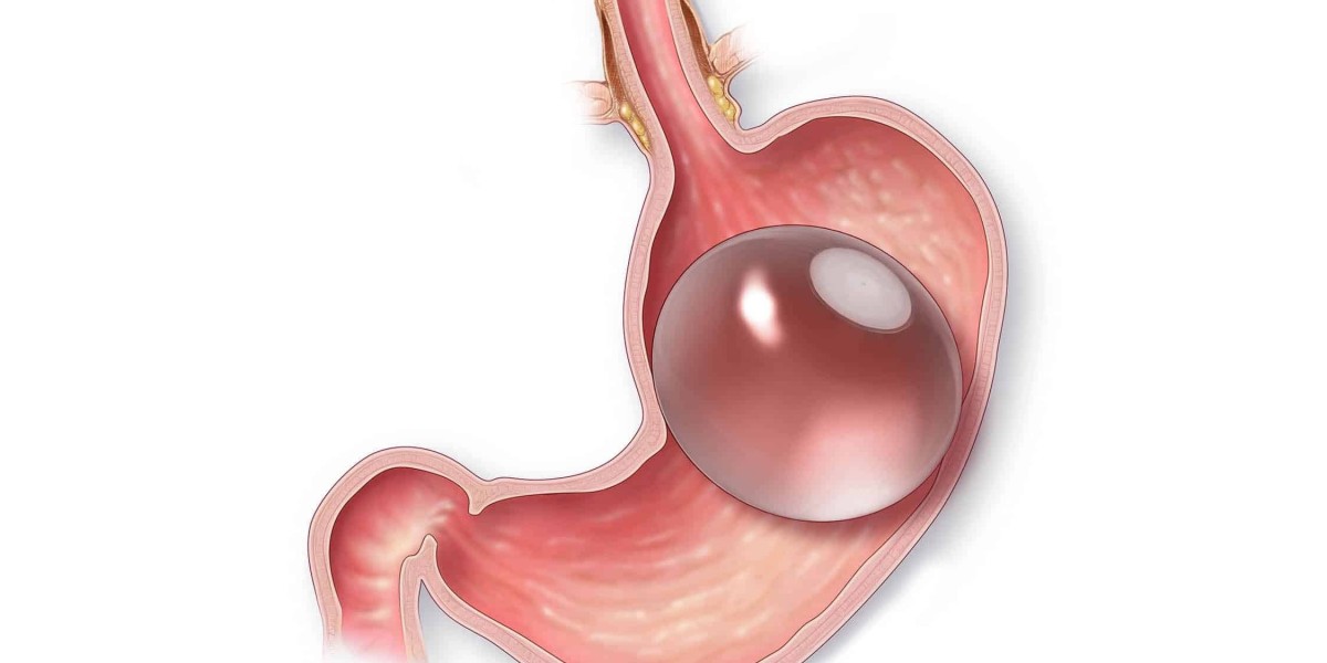 Gastric Balloon Placement for Obesity