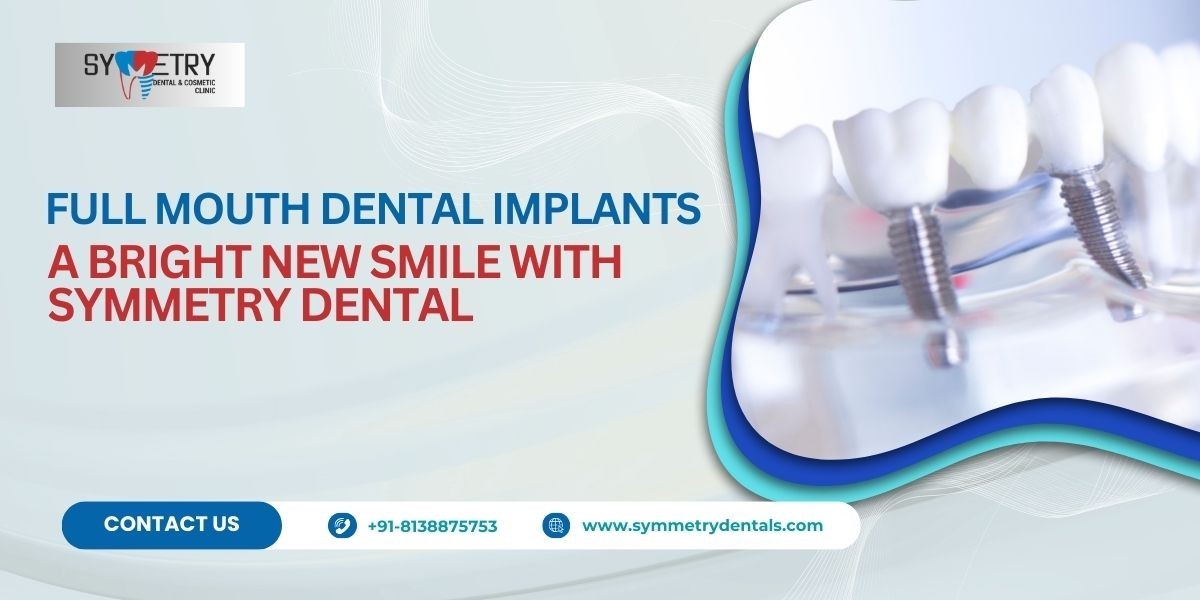 Full Mouth Dental Implants: A Bright New Smile