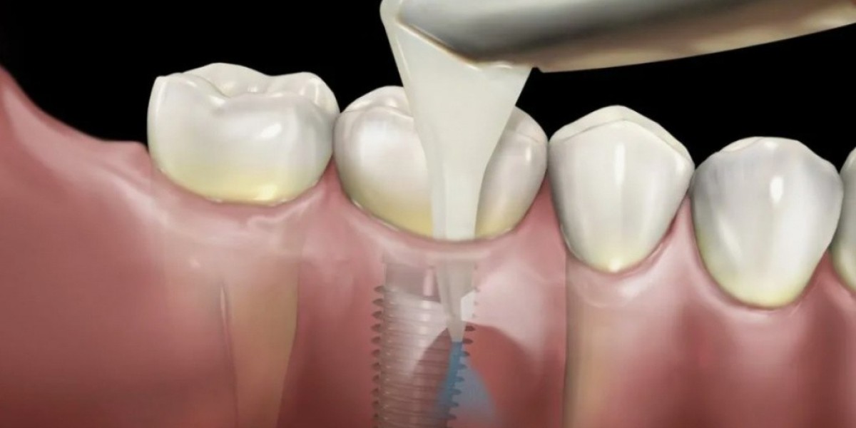 Understanding Peri-Implantitis Market Dynamics