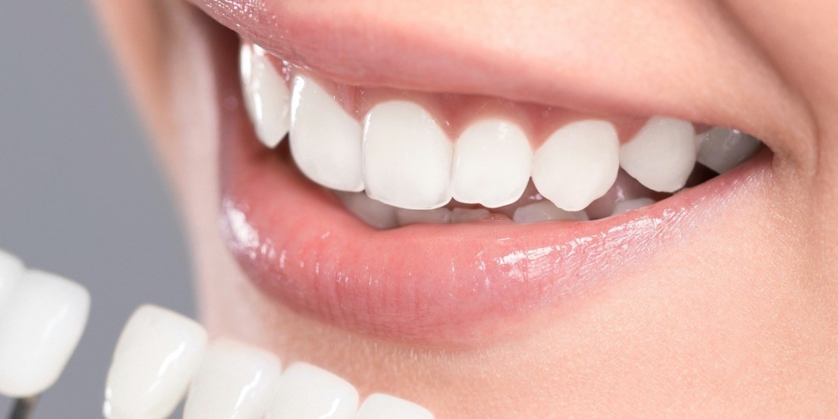 Do Veneers Look Natural?