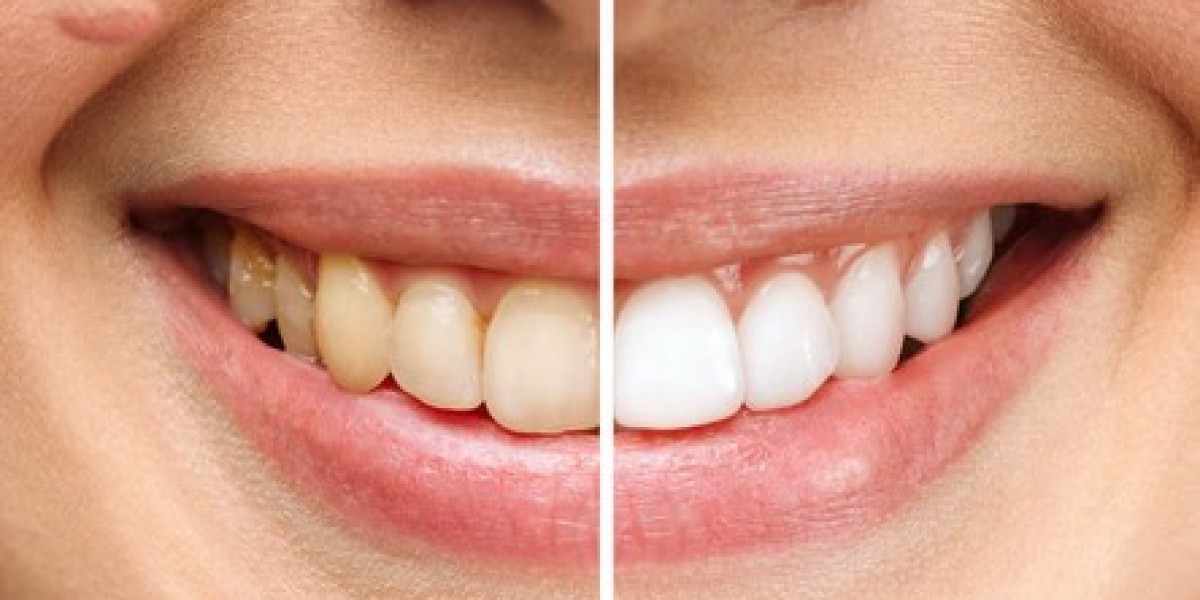 ProDentim Review: Oral Health Supplement
