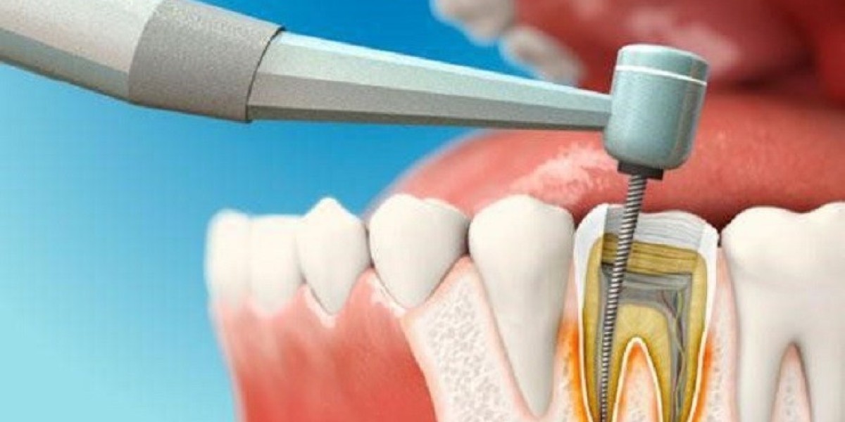 Root Canal Treatment for Cracked Teeth Solution