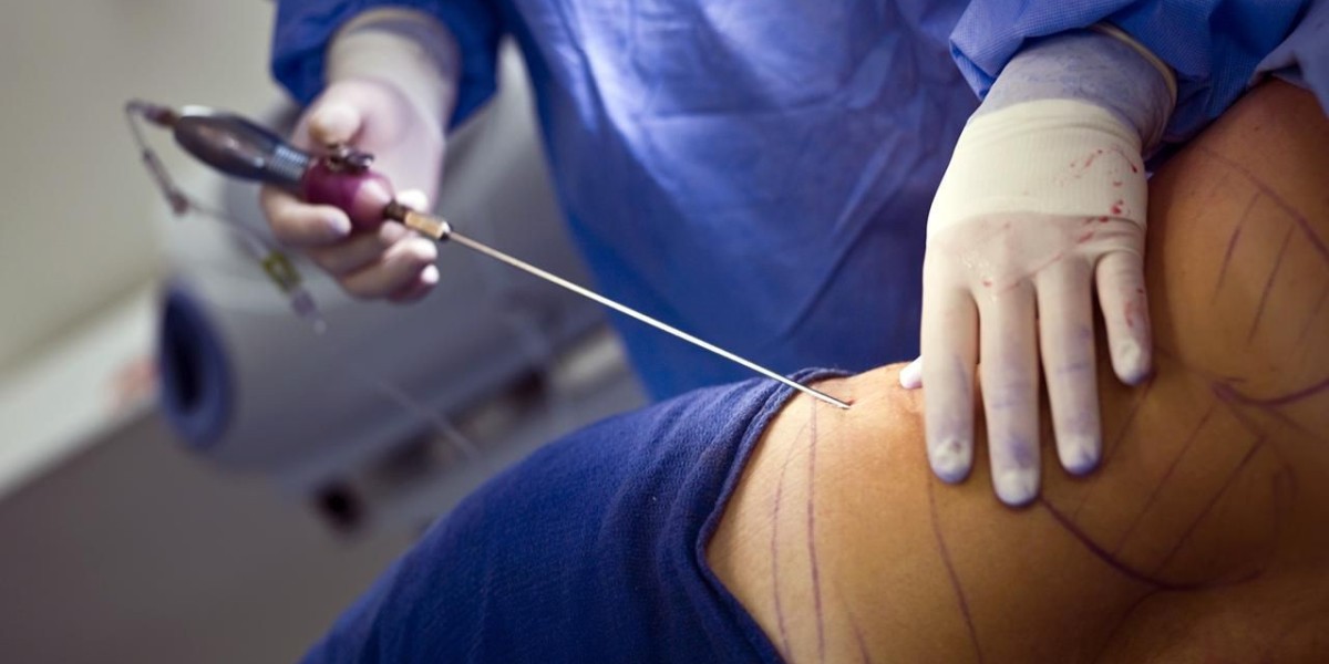 Dream Shape with Liposuction in Islamabad