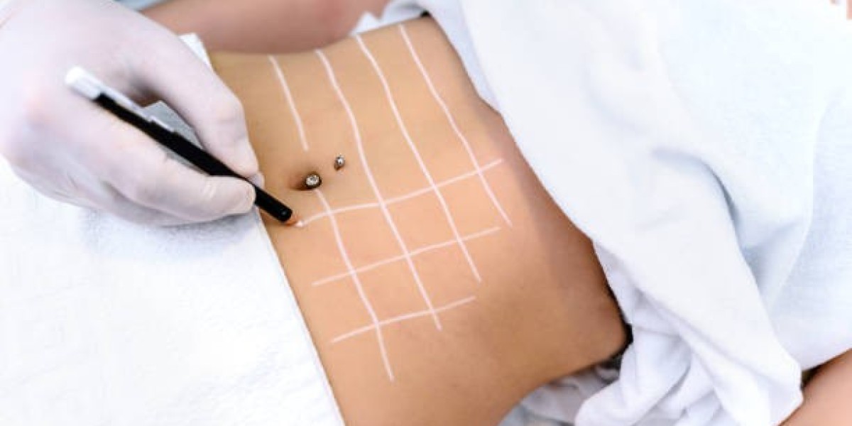 Liposuction Cost Explained: What You Need to Kn