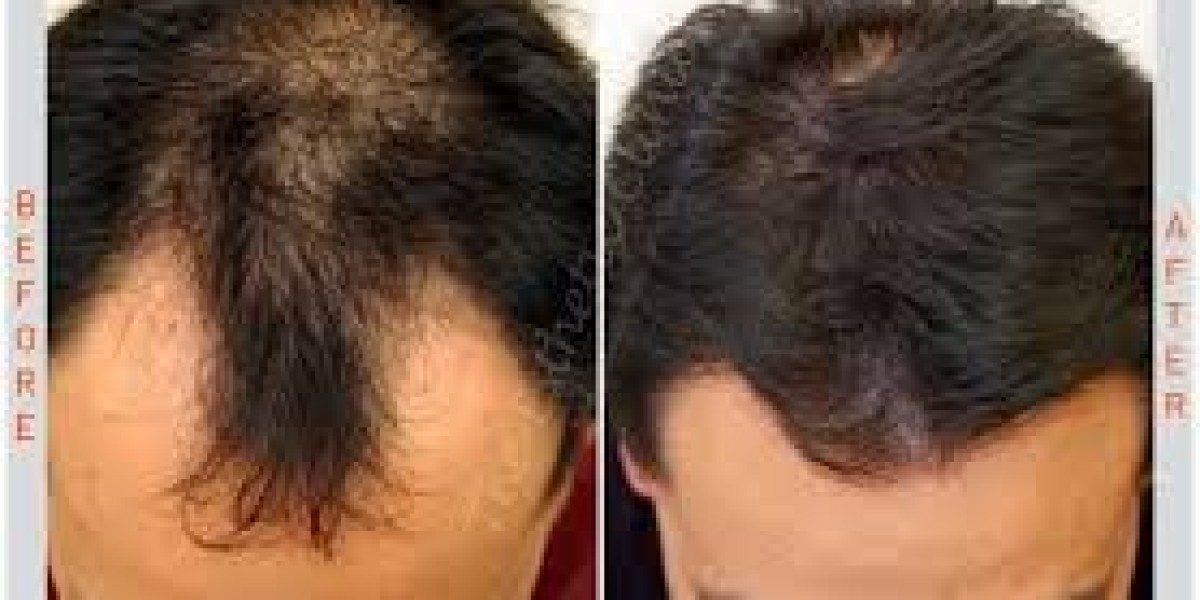Transforming Hair Growth with Exosome Hair Ther