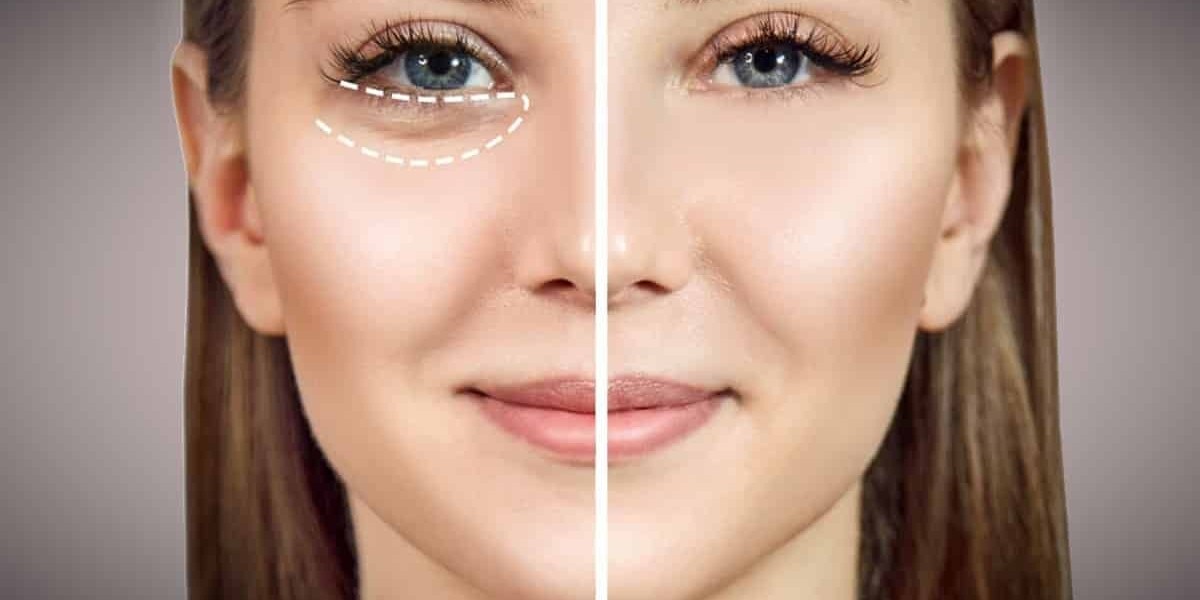 Combining Eye Bag Removal with Other Aesthetic