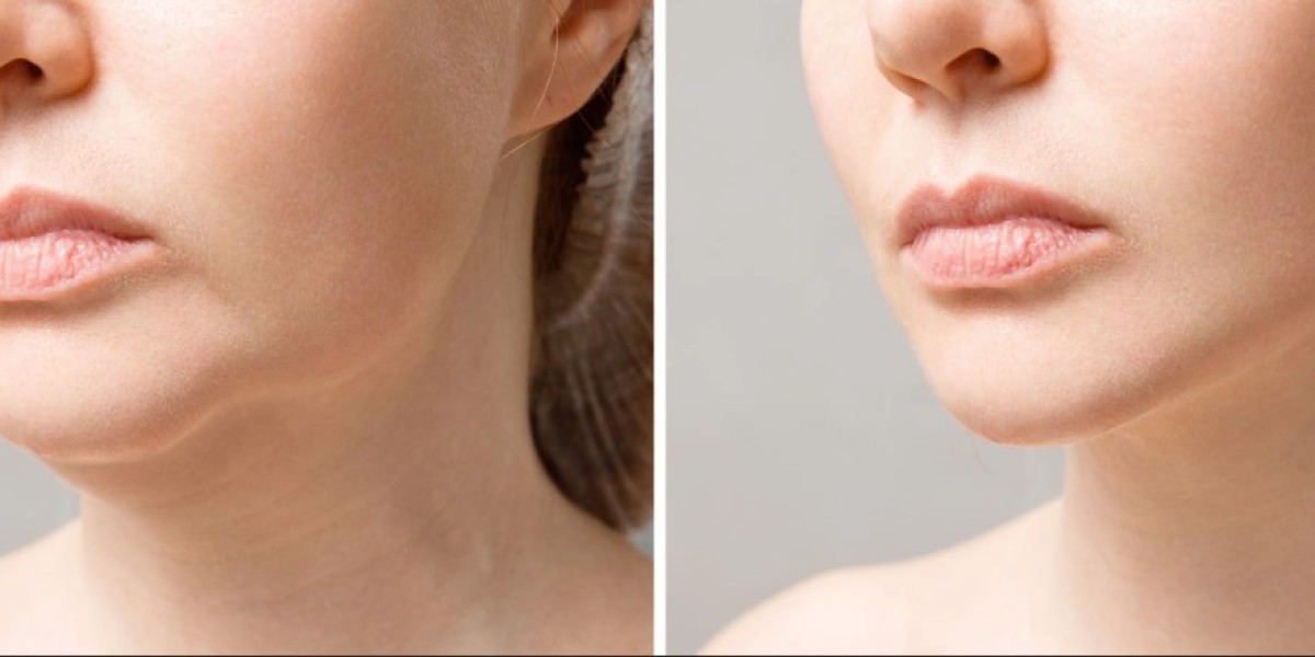 Pain Management During Double Chin Removal Reco