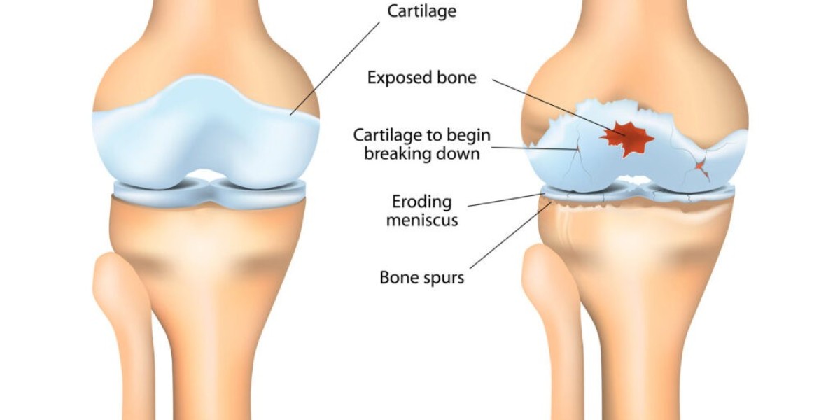 Osteoarthritis ICD 10 Complete Guide