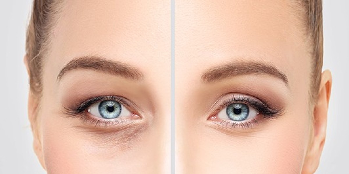 10 Recovery Tips That Make Eyelid Surgery Easie