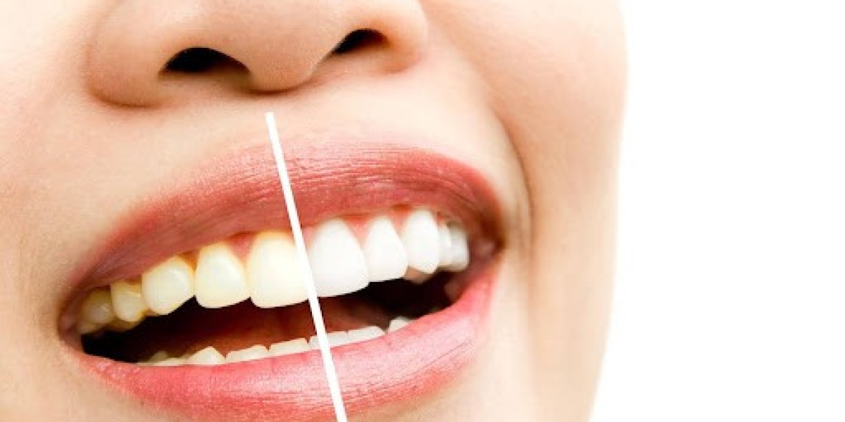Teeth Whitening Before and After: What to Expec