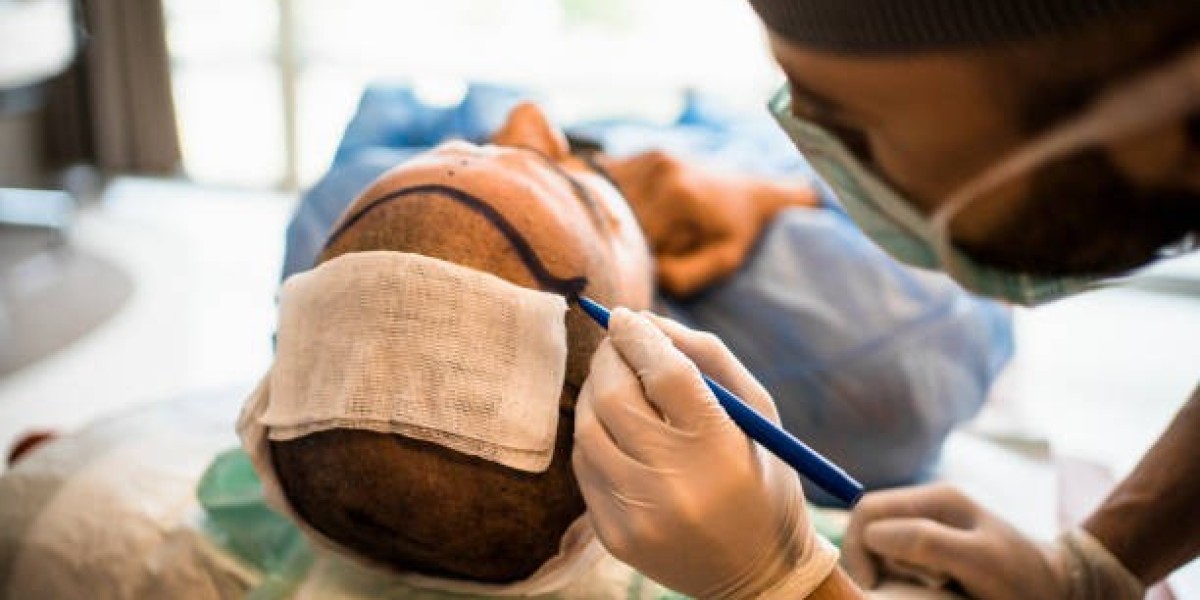 Hair Transplant in Dubai: FUE vs FUT Methods